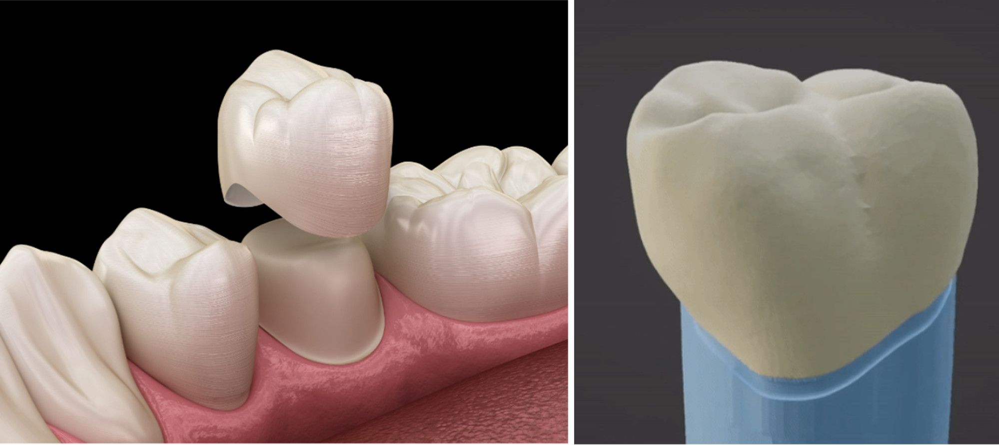 Dental crowns feature complex, organic geometries that vary with every patient.