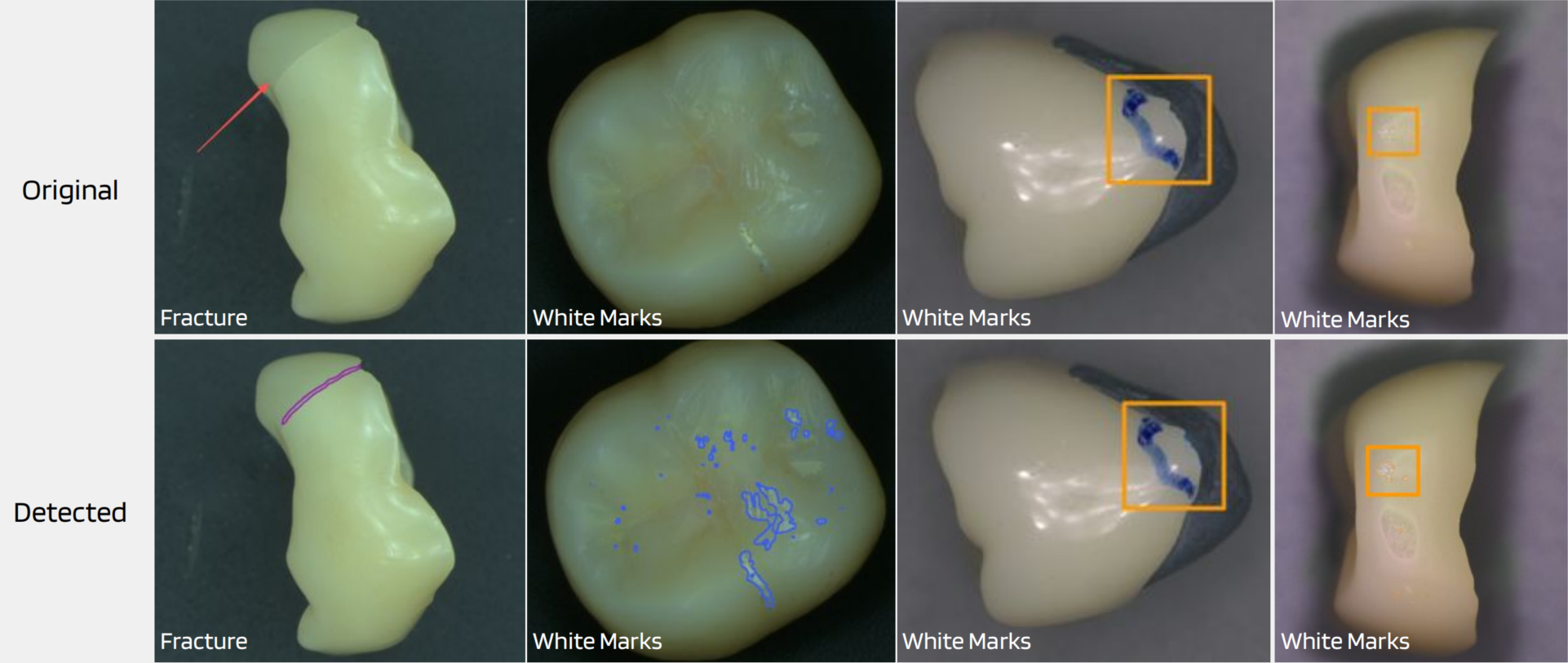 UnitX AI accurately identifies fractures and white marks on the unique topography of each crown.
